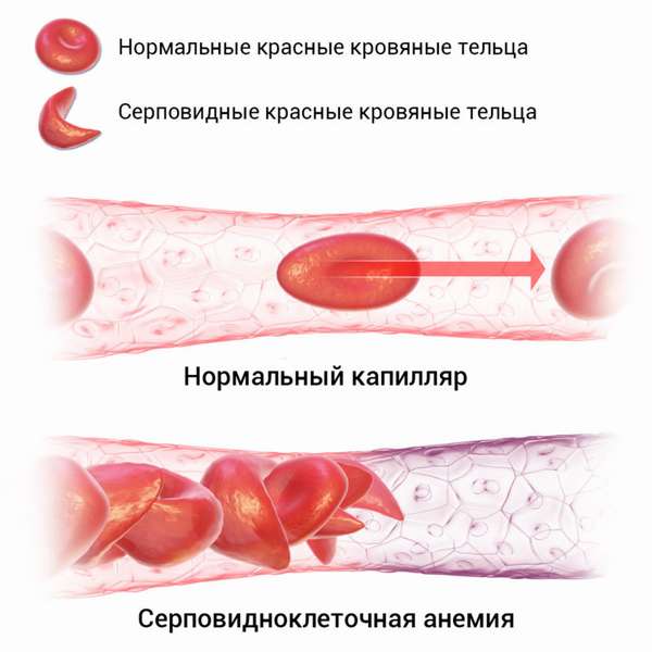 серповидноклеточная анемия